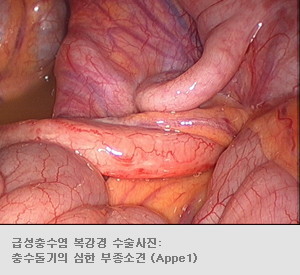 급성충수염 복강경 수술사진: 충수돌기의 심한 부종소견(Appe1)