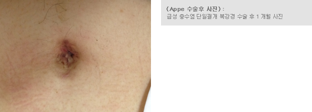 (Appe 수술후 사진) - 급성 충수염 단일절개 복강경 수술 후 1 개월 사진