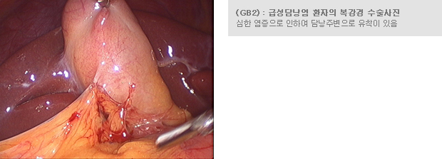 (GB2) - 급성담낭염 환자의 복강경 수술사진 - 심한 염증으로 인하여 담낭주변으로 유착이 있음