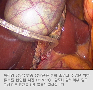 복강경 담낭수술중 담낭관을 통해 조영제 주입을 위한 튜브를 삽입한 사진 (OPC 1) - 담도내 담석 여부, 담도 손상여부 진단을 위해 필요시 검사합니다.